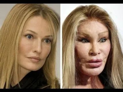 Пластическая хирургия звезд: когда стремление к идеалу становится кошмаром