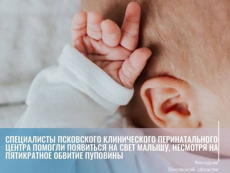 В Пскове врачи помогли родиться девочке с пятикратным обвитием пуповины